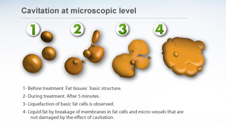 Nonsurgical_liposuction_downsize